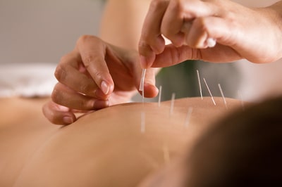 Person performing acupuncture on a patient's back.